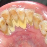 Dampak Karang Gigi Terhadap Kesehatan Mulut Dan Gigi