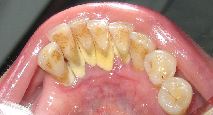Dampak Karang Gigi Terhadap Kesehatan Mulut Dan Gigi
